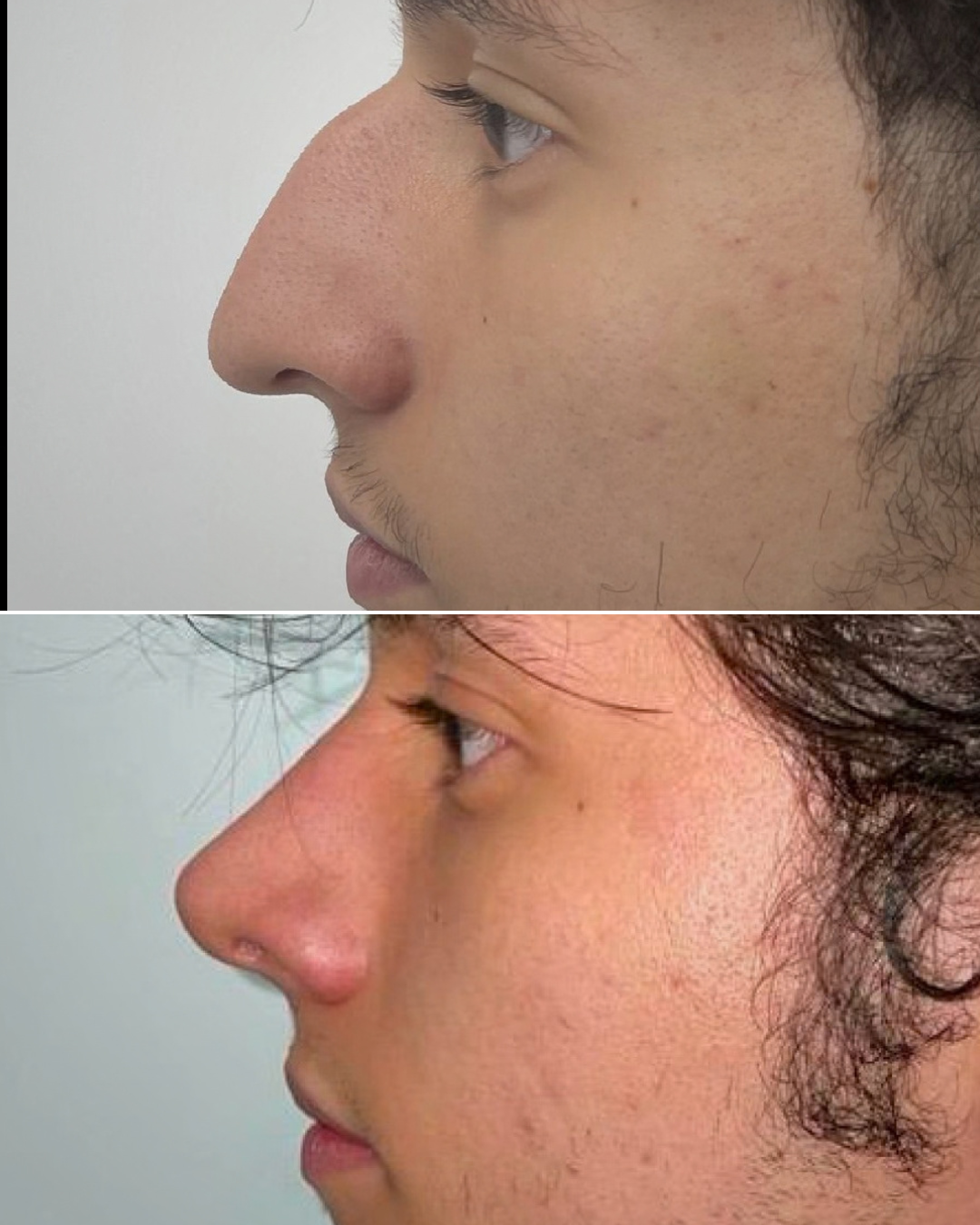 Resultado de rinoplastia, caso real, antes y después