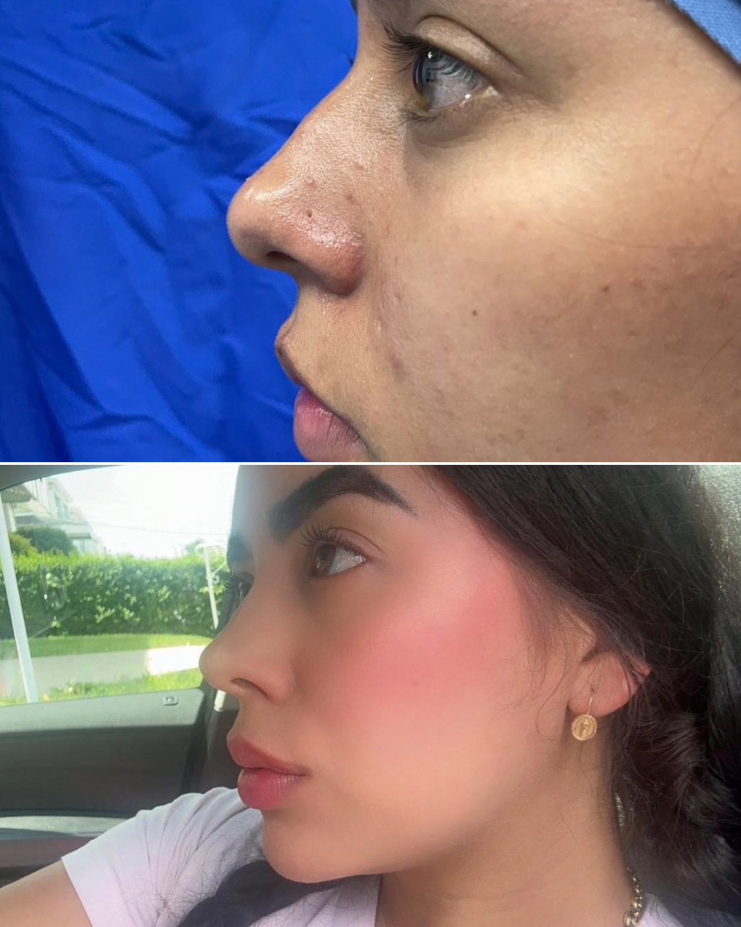 Resultado de rinoplastia, caso real, antes y después