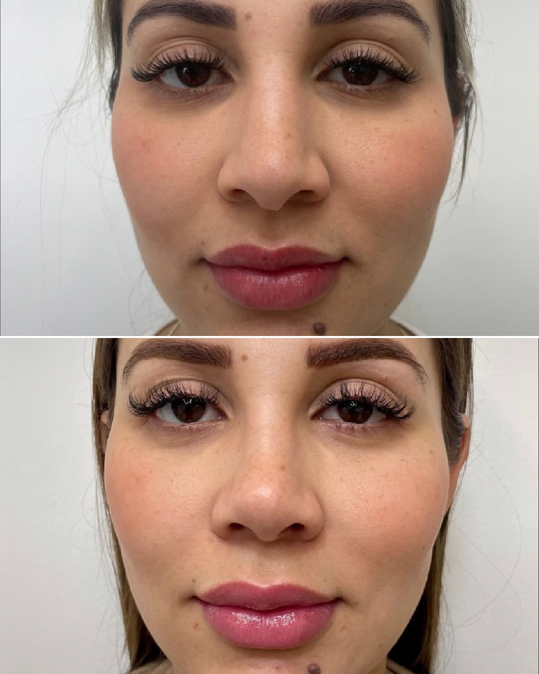 Resultado de rinoplastia, caso real, antes y después