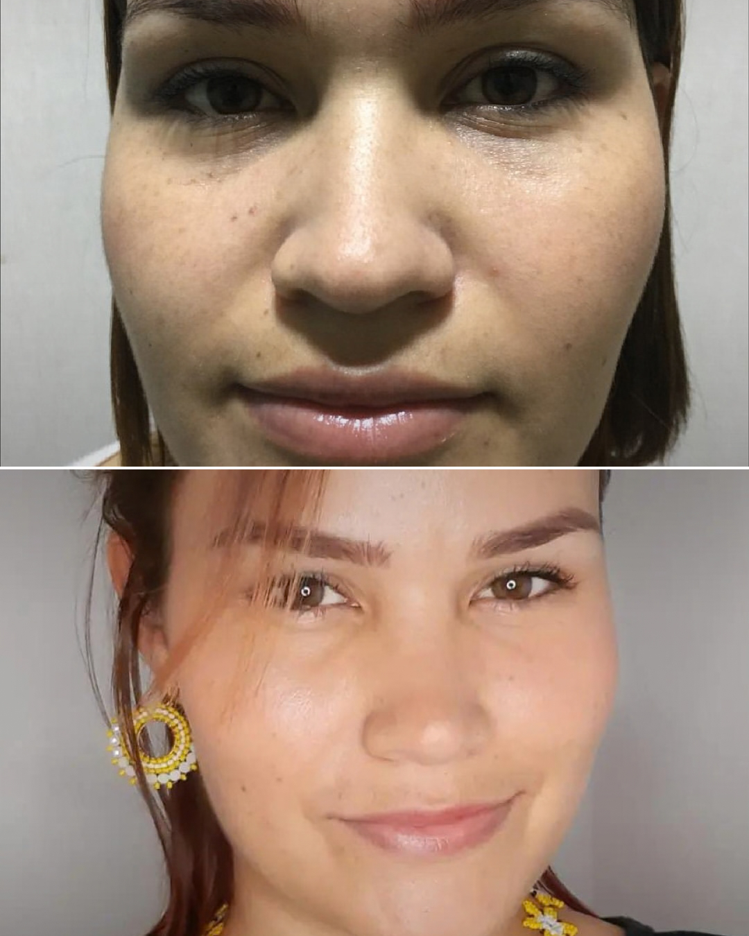 Resultado de rinoplastia, caso real, antes y después