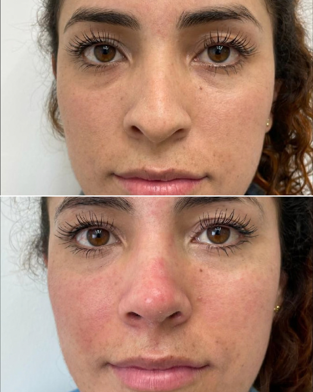 Resultado de rinoplastia, caso real, antes y después