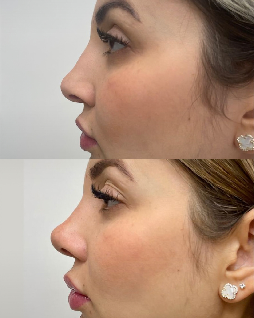 Resultado de rinoplastia, caso real, antes y después