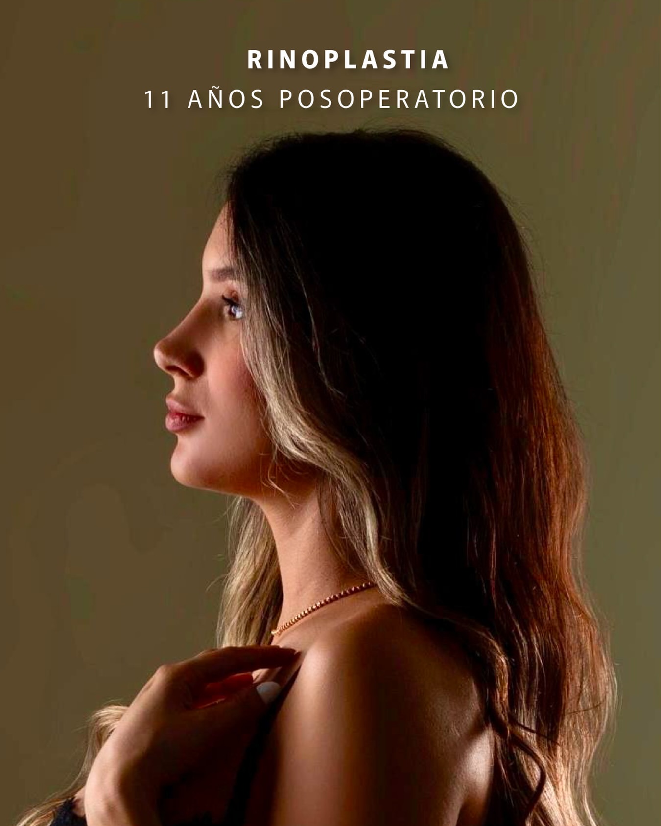Paciente del Dr. Cardona, resultado de rinoplastia