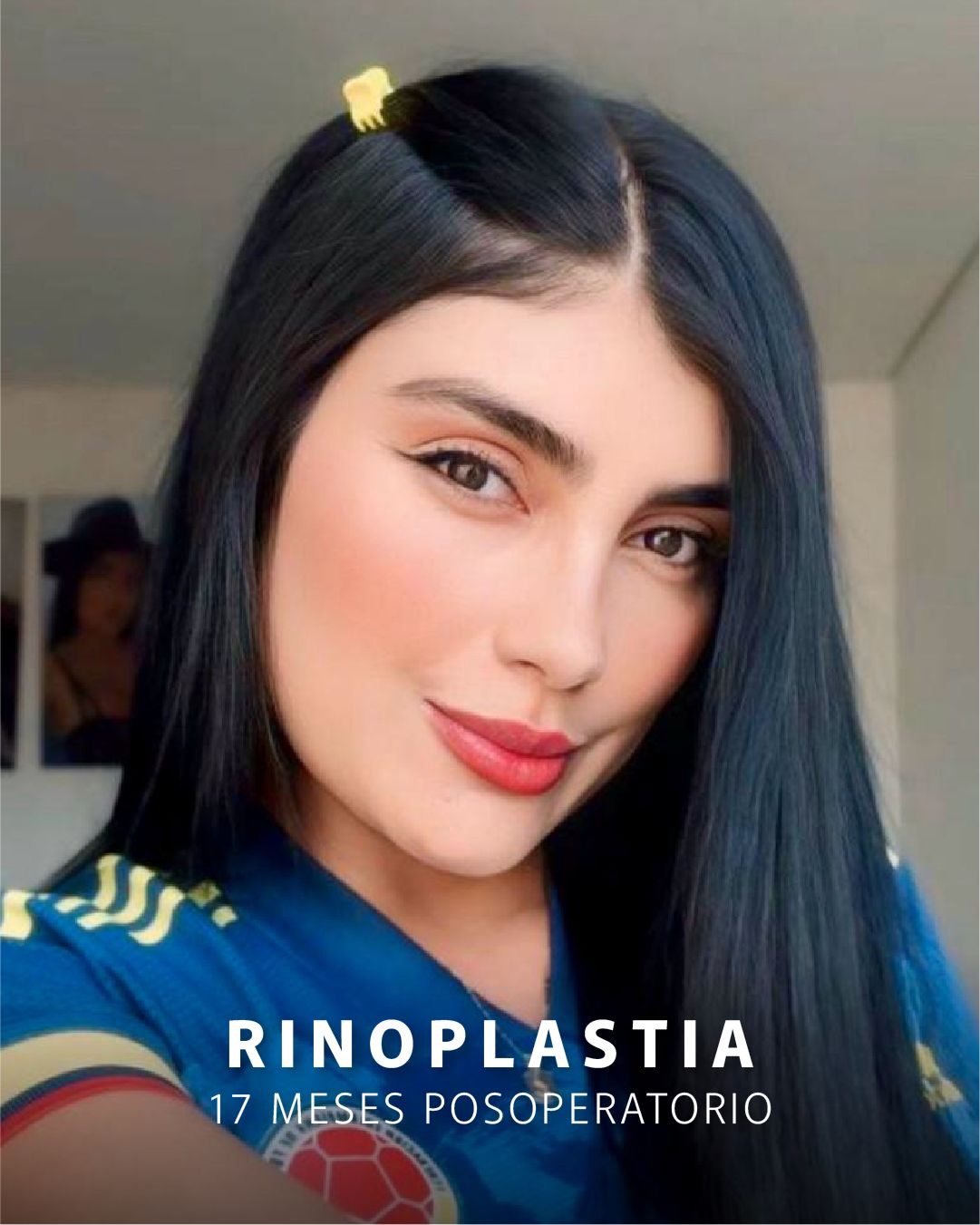 Paciente del Dr. Cardona, resultado de rinoplastia