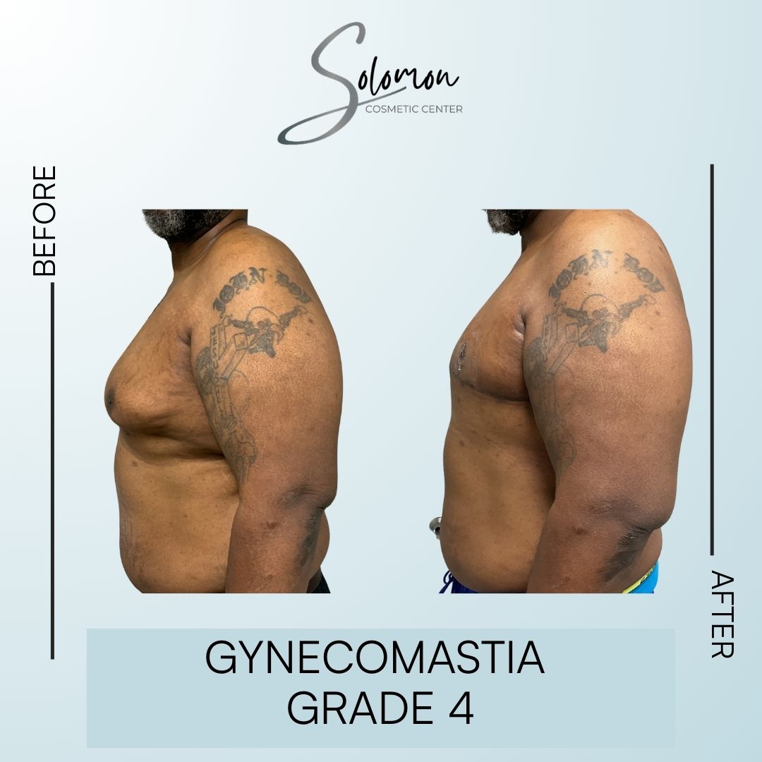 Gynecomastia before and after - Grade 2