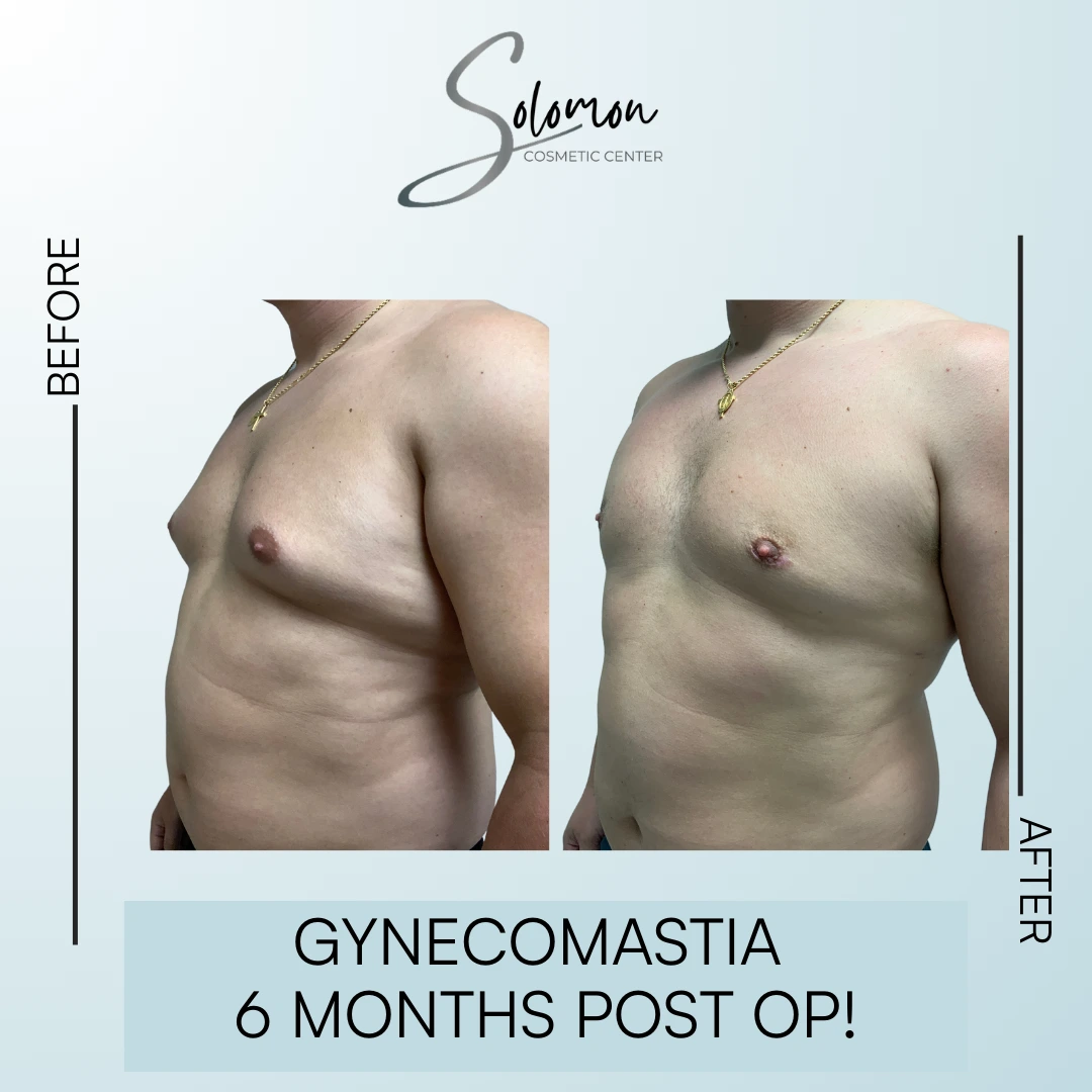 Gynecomastia before and after - Grade 4