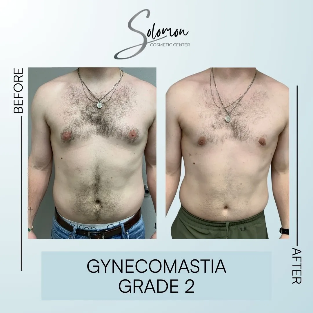 Gynecomastia before and after - 6 months post op