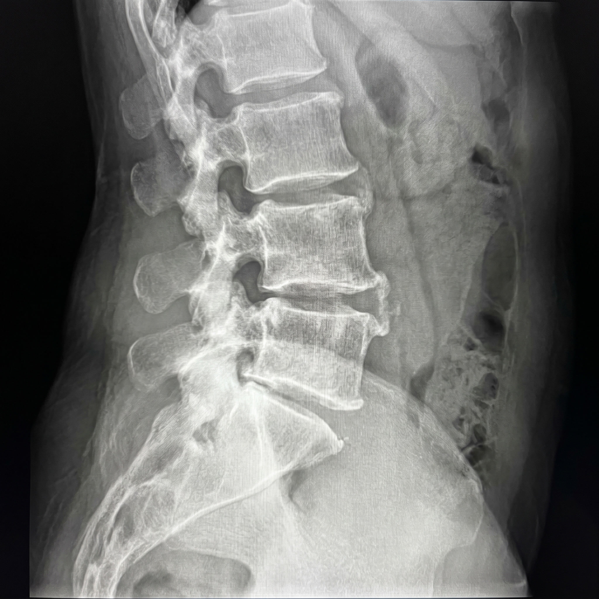 Cross-section of the lumbar spine showing spinal stenosis narrowing