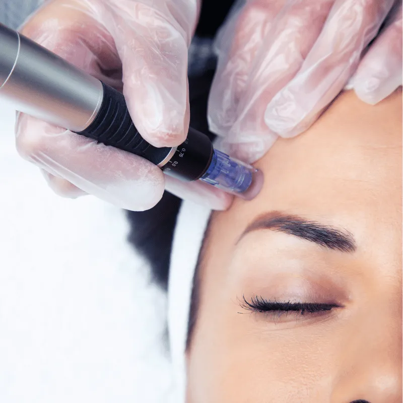 Project Esty microneedling treatment