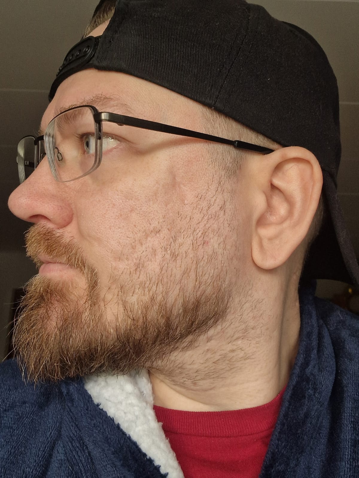 Subcision & Microneedling &mdash; efter
