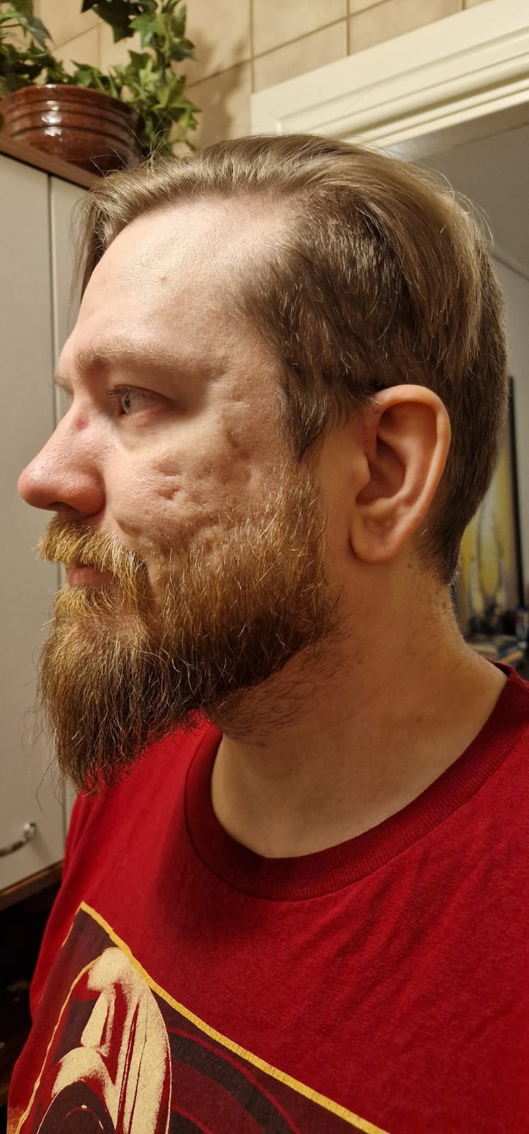 Subcision & Microneedling &mdash; f&ouml;re
