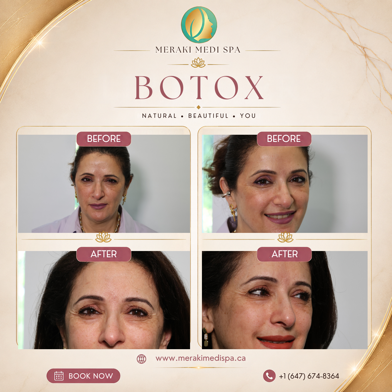 Before and after — Meraki Client · Botox
