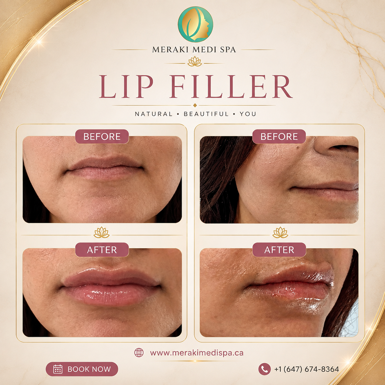 Before and after — Meraki Client · Lip Filler