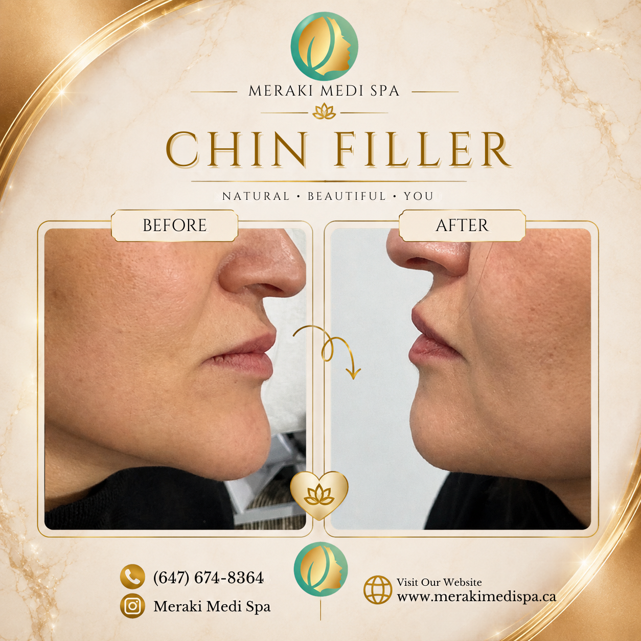 Before and after — Meraki Client · Chin Filler