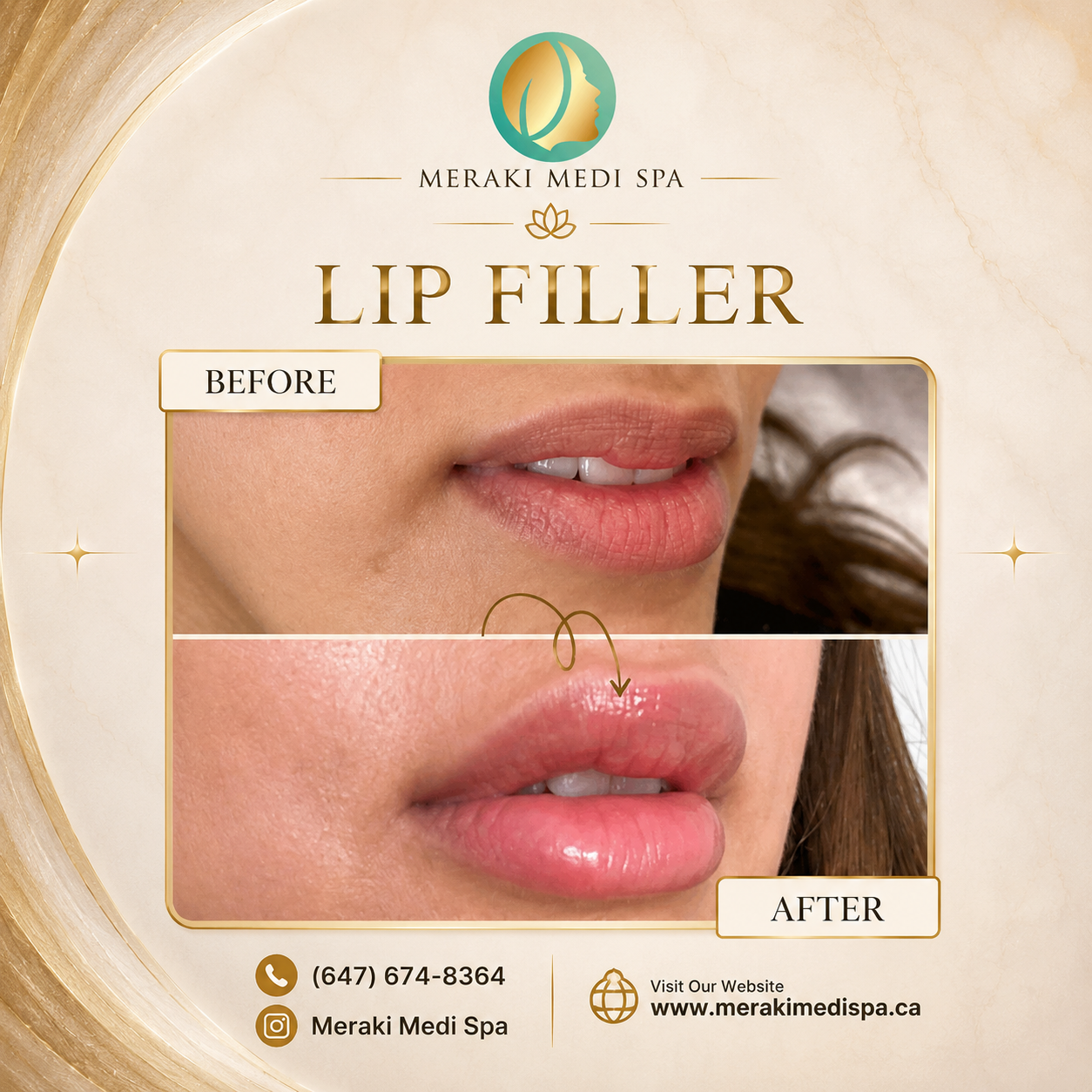 Before and after — Meraki Client · Lip Filler