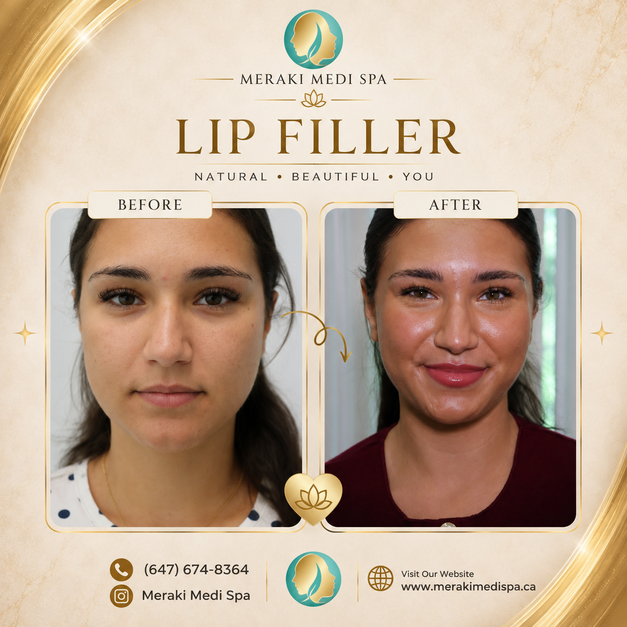 Before and after — Meraki Client · Lip Filler