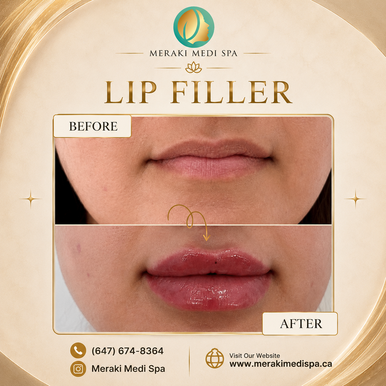 Before and after — Meraki Client · Lip Filler