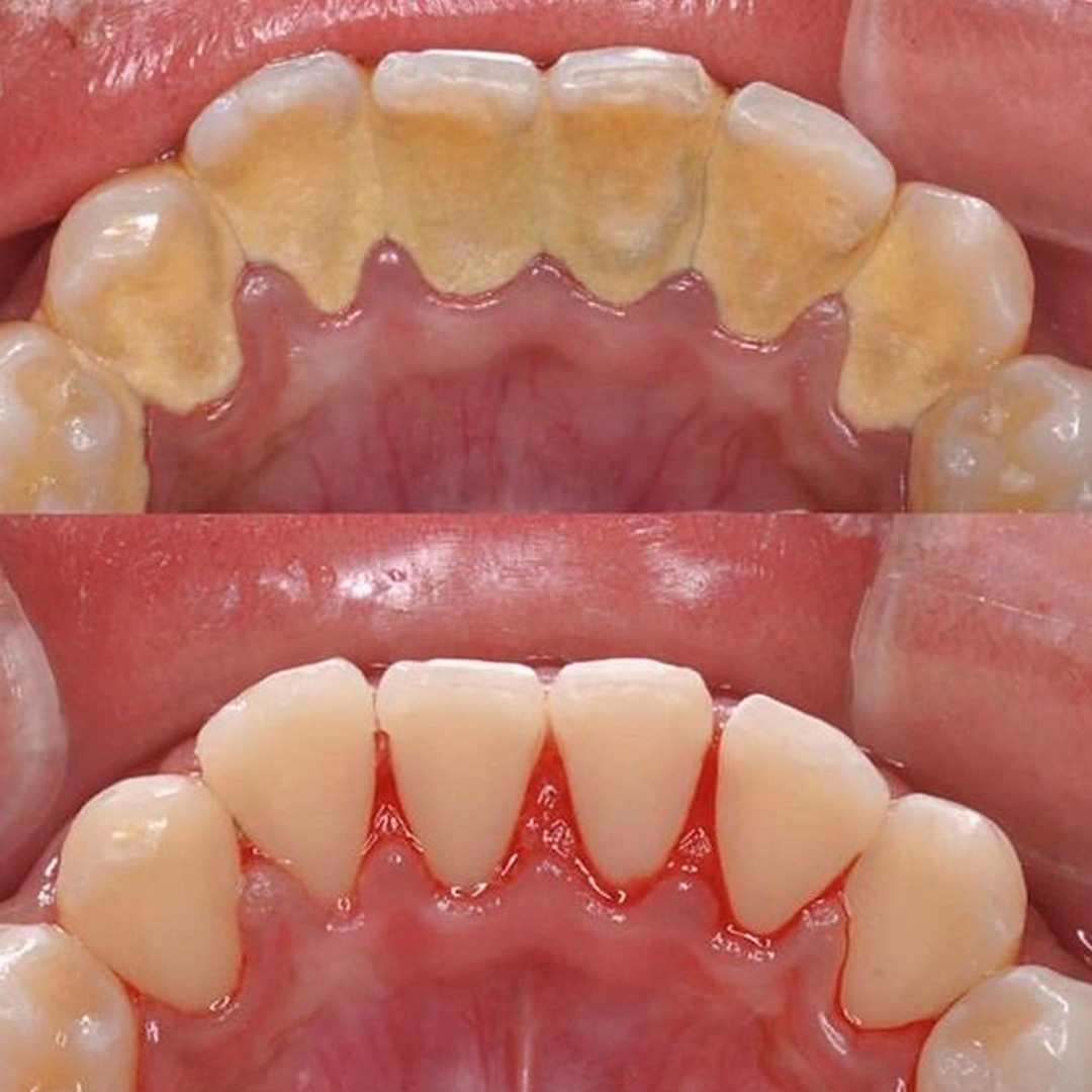 Caso antes y después de limpieza dental 3