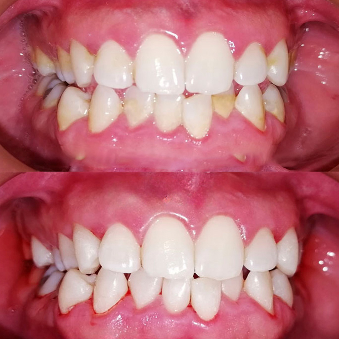 Caso antes y después de limpieza dental 2
