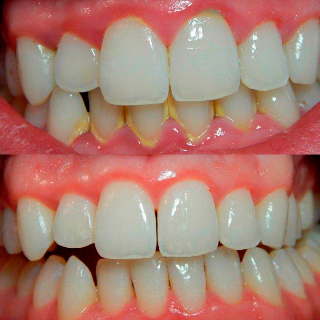 Caso antes y después de limpieza dental 1