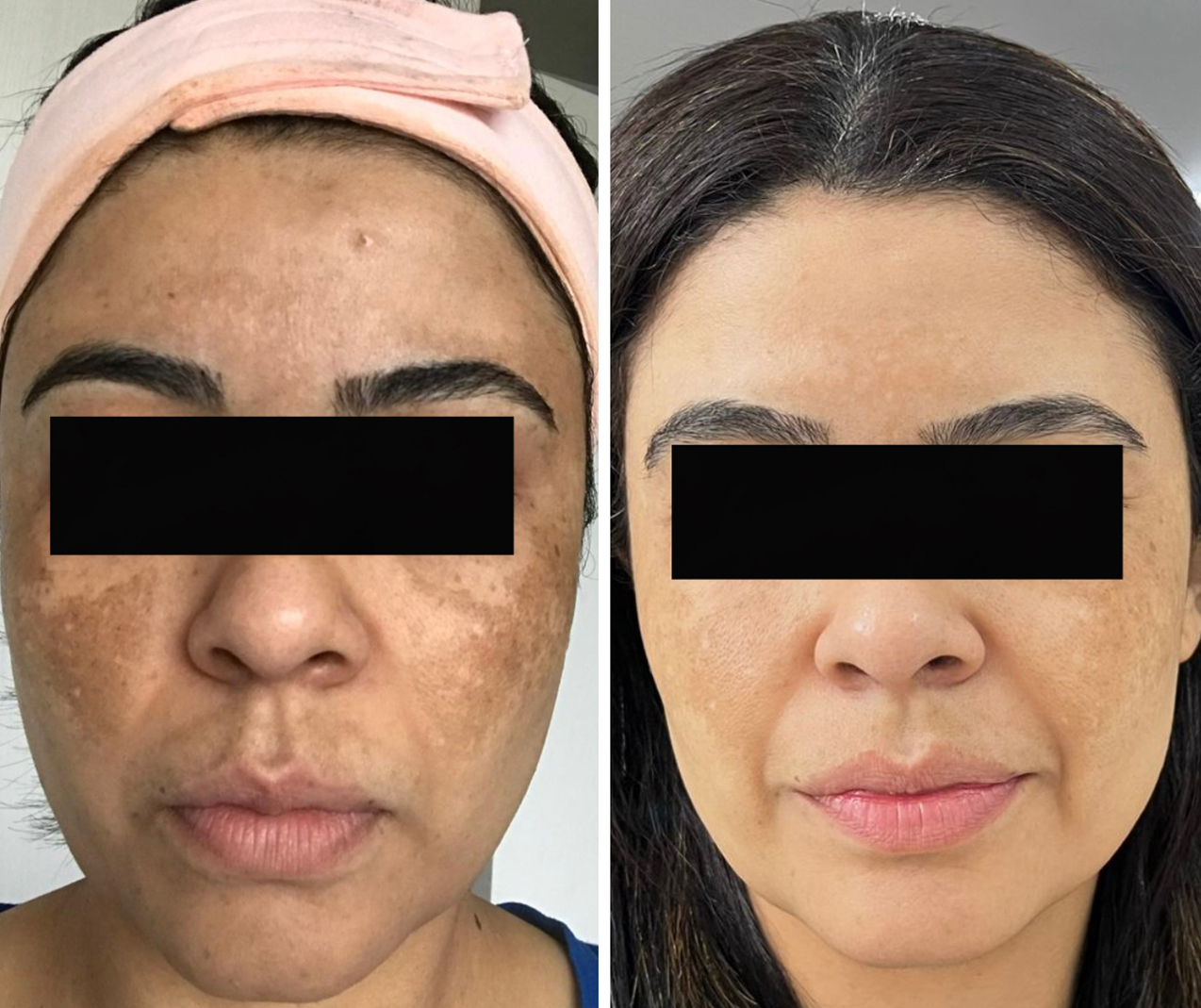 Comparativo clínico de antes e depois — resultado 6
