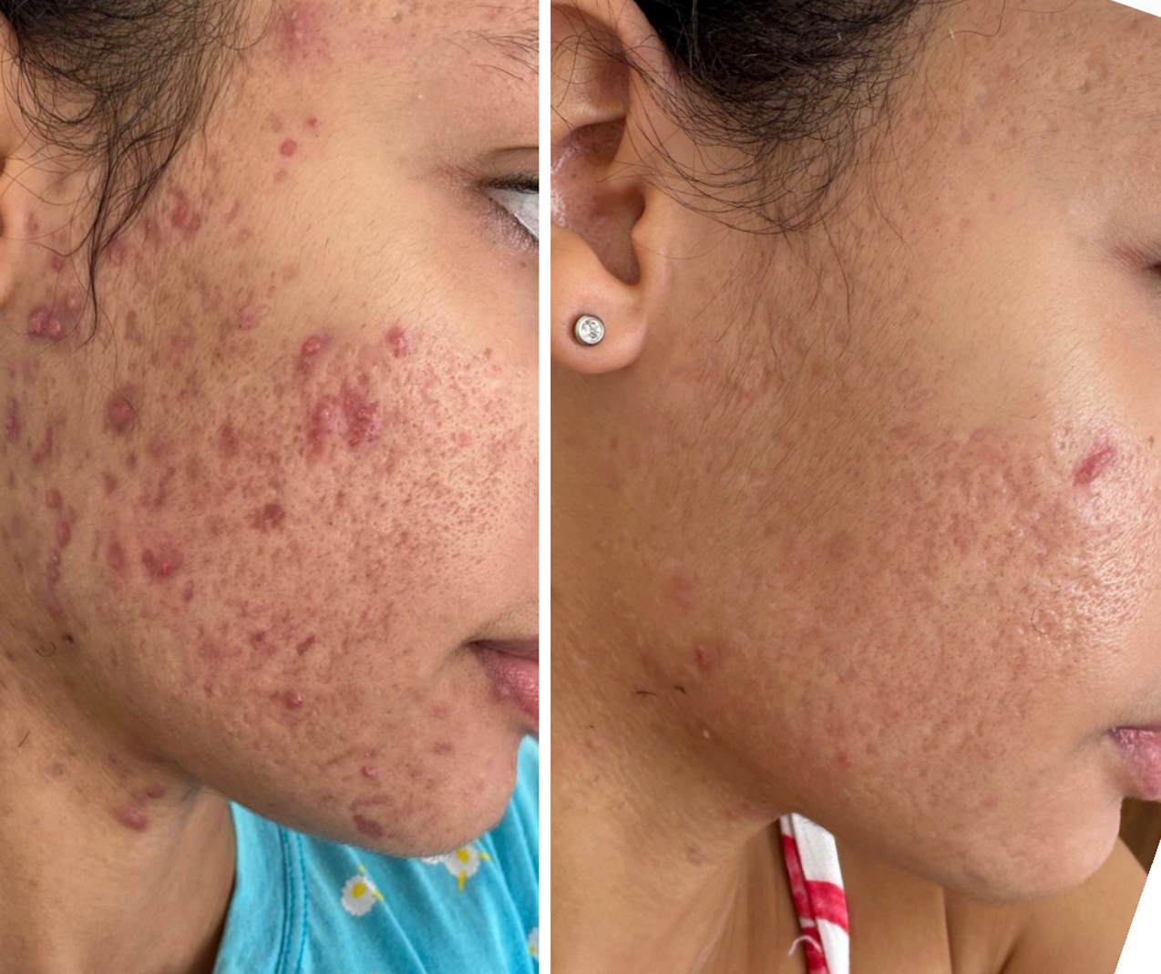 Comparativo clínico de antes e depois — resultado 2