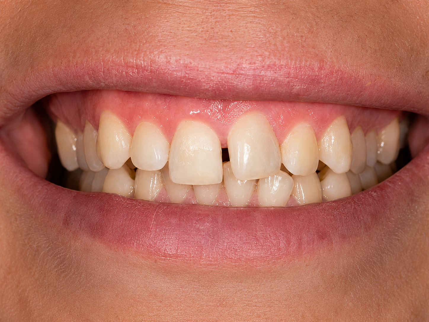Invisalign alignment transformation before