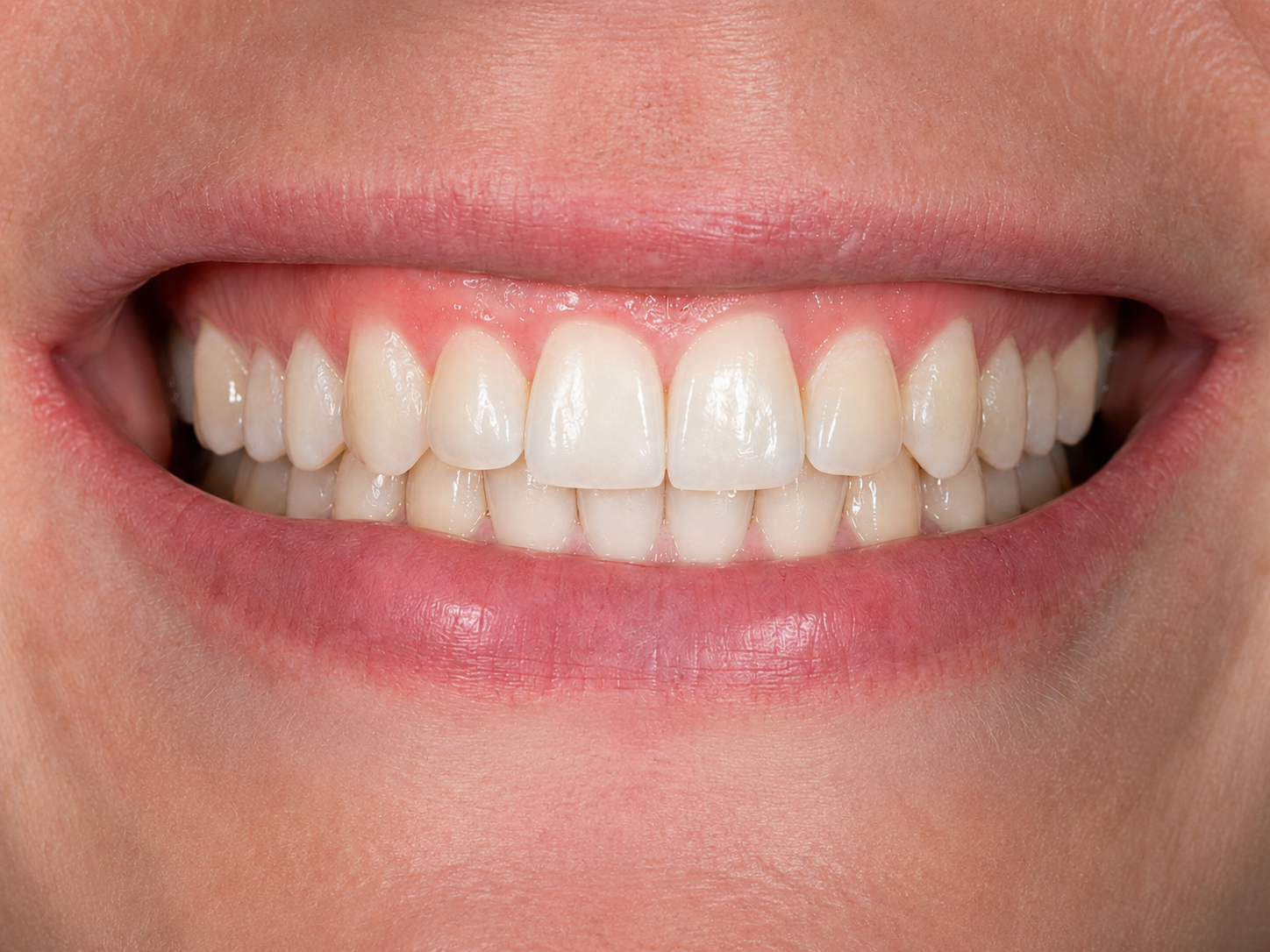Invisalign alignment transformation after