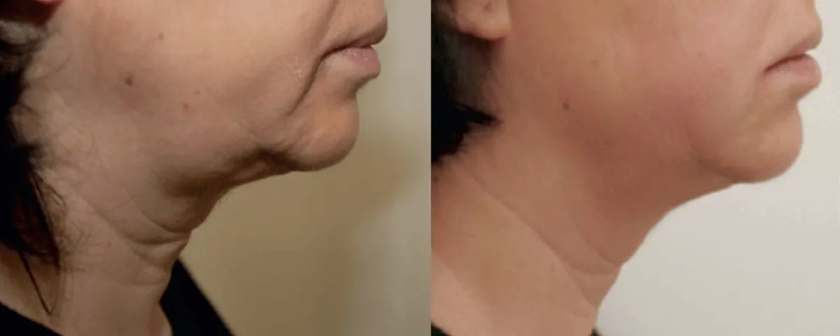 Ultraformer MPT HIFU before and after result 2