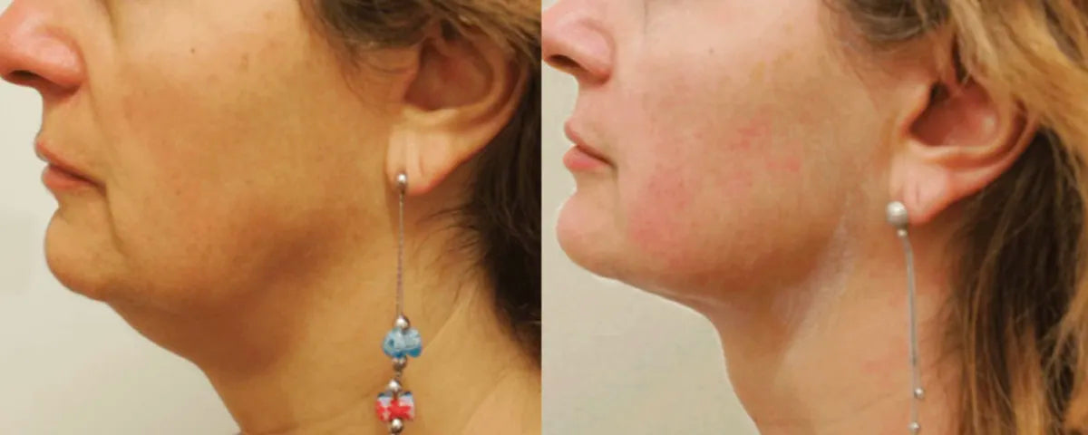 Ultraformer MPT HIFU before and after result 3