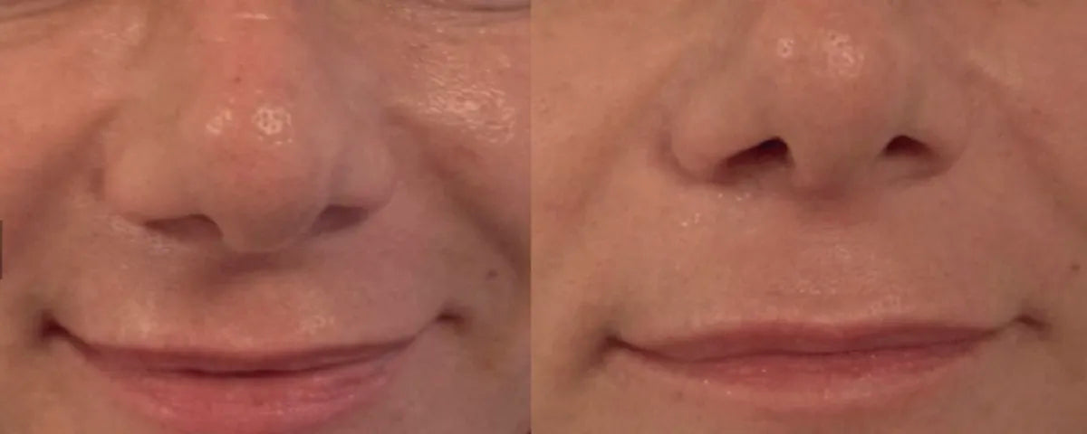 Ultraformer MPT HIFU before and after result 1