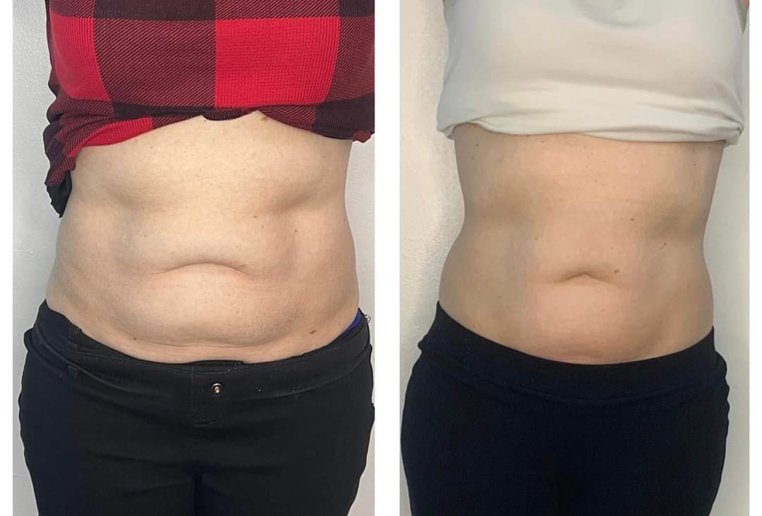 Cryo Body Sculpting Before and After