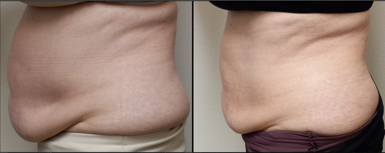 Cryo Body Sculpting Results