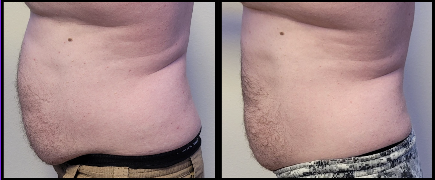 Cryo Body Sculpting Before and Afters