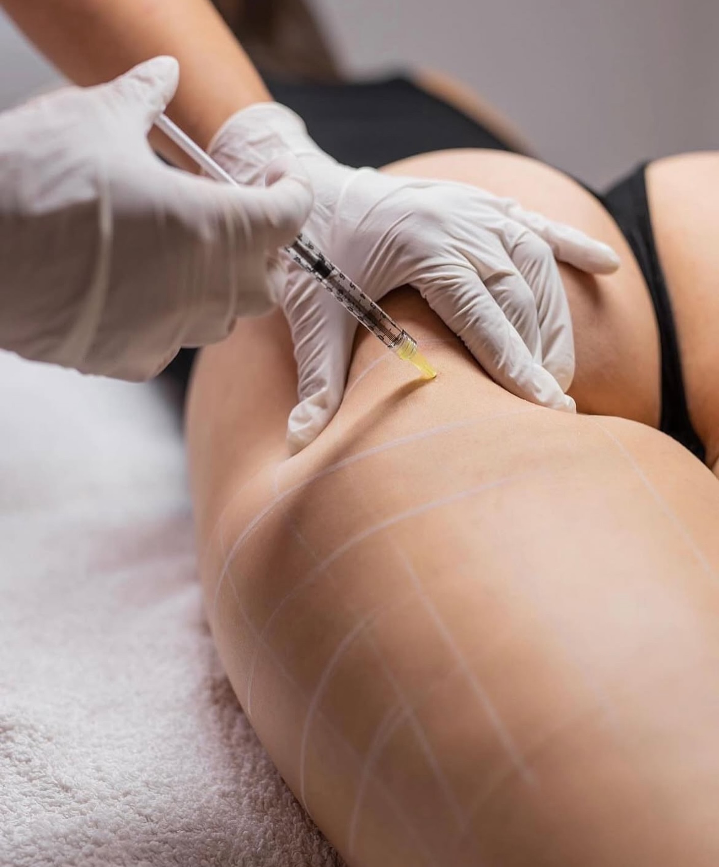 Introducing the Game-Changer in Hip Sculpting: PLLA Collagen Builder by Mold Manila Introducing the Game-Changer in Hip Sculpting: PLLA Collagen Builder by Mold Manila