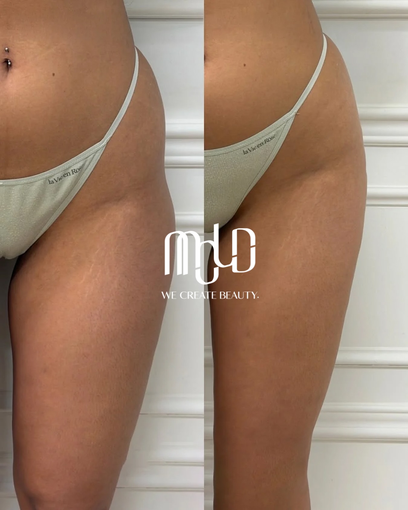 Introducing the Game-Changer in Hip Sculpting: PLLA Collagen Builder by Mold Manila Introducing the Game-Changer in Hip Sculpting: PLLA Collagen Builder by Mold Manila