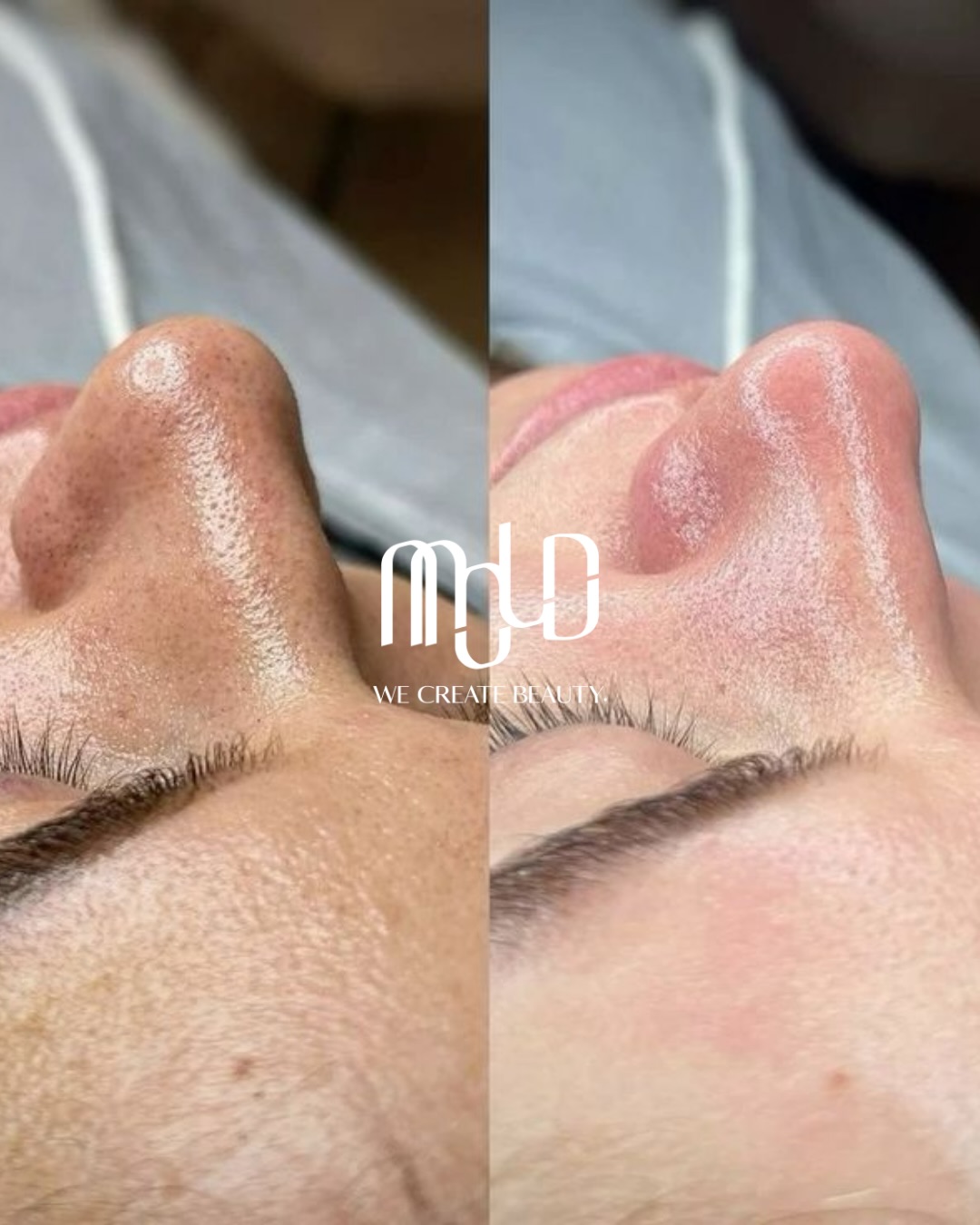 HydraFacial Signature Reset for SPF Buildup: Expert Pore Cleansing and Skin Renewal