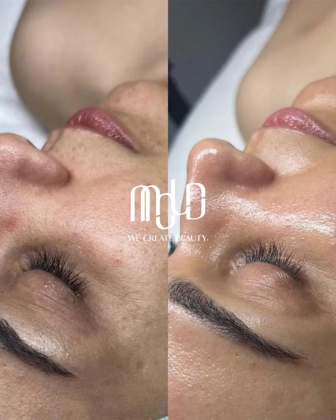 HydraFacial Signature Reset for SPF Buildup: Expert Pore Cleansing and Skin Renewal