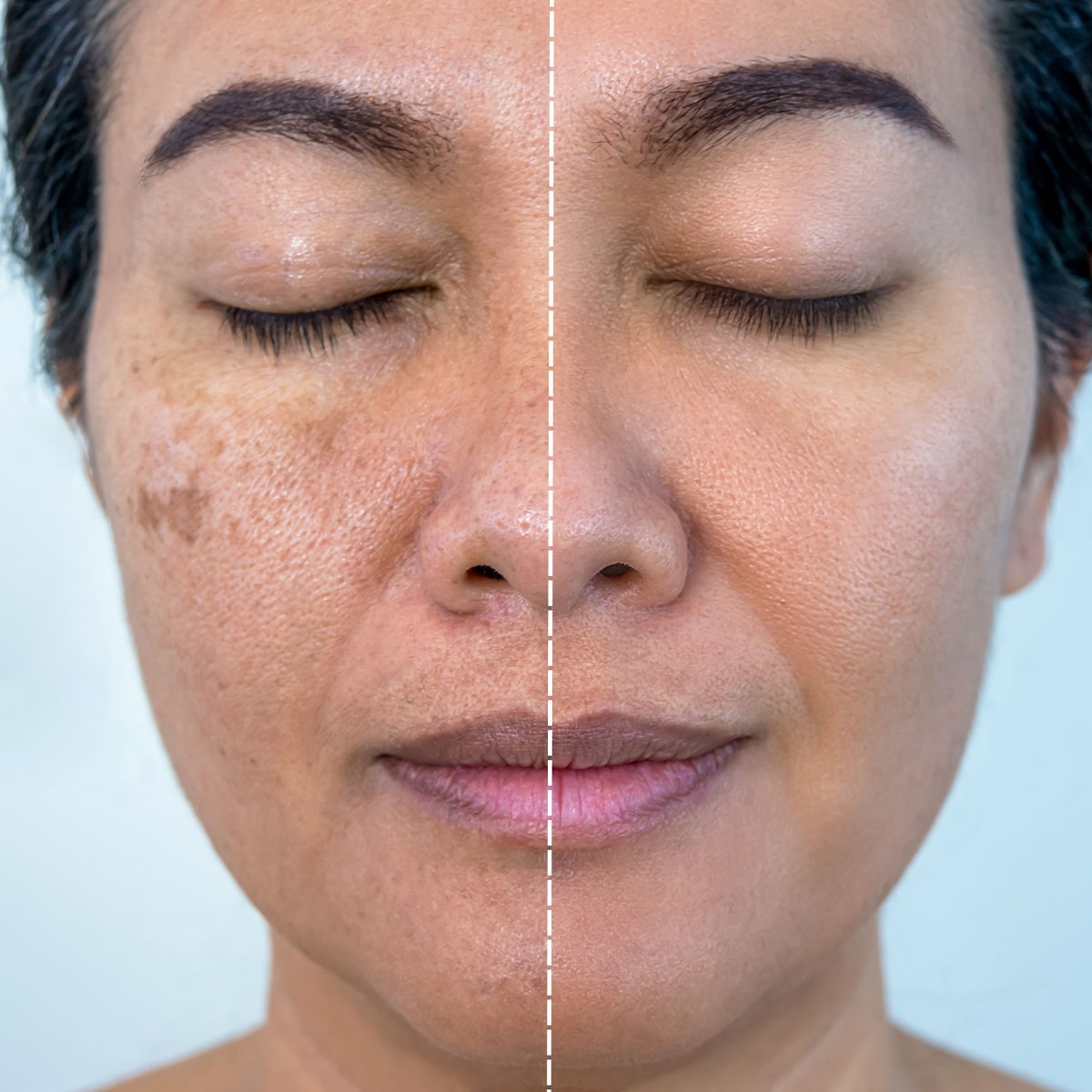 melasma