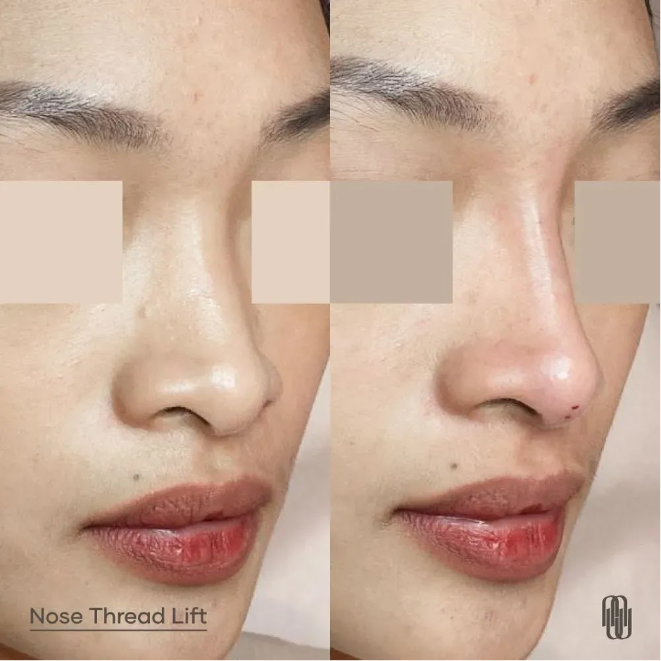 nose thread lift