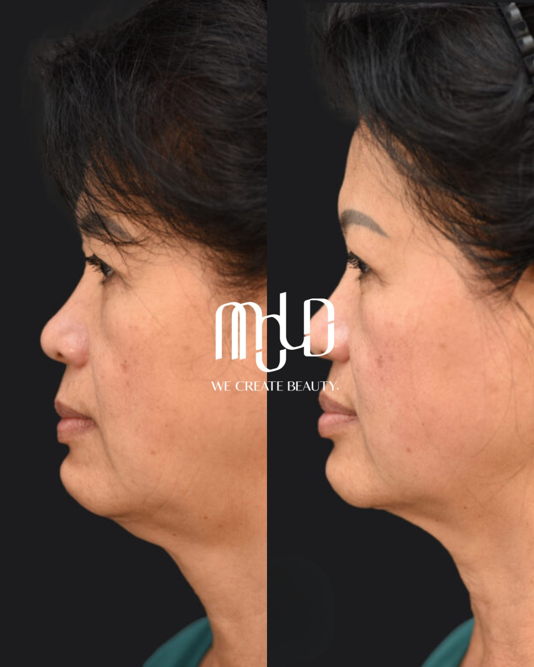 Before and after XERF RF Skin Tightening showing improved firmness and facial definition with minimal downtime. Before and after XERF RF Skin Tightening showing improved firmness and facial definition with minimal downtime.
