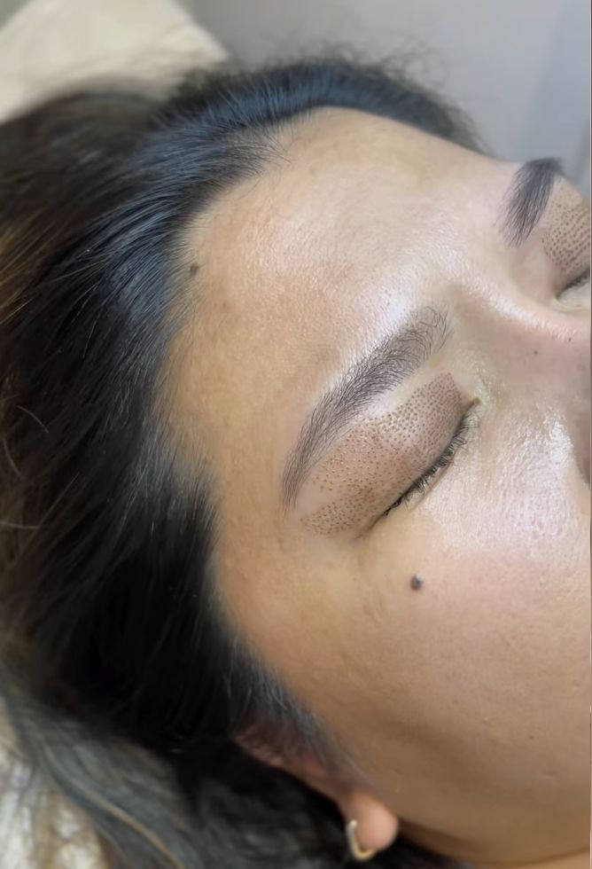 Plasma Lift treatment targets loose skin and fine lines with precision for a firmer, refreshed appearance. Plasma Lift treatment targets loose skin and fine lines with precision for a firmer, refreshed appearance.