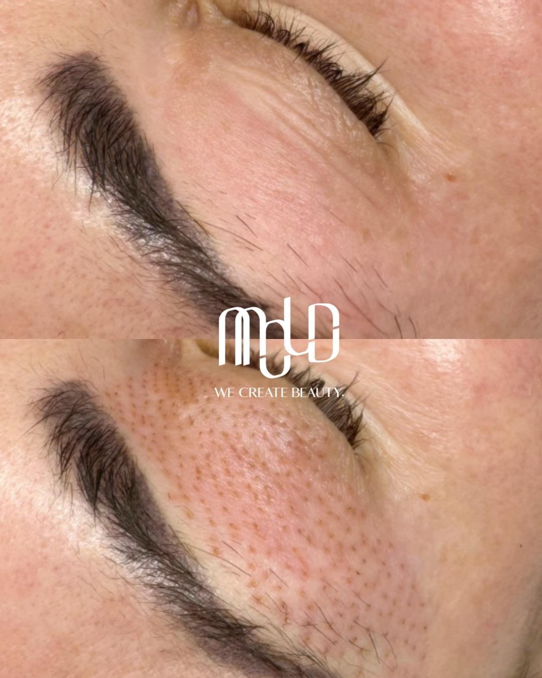 Before and after treatment showing improved skin texture and a smoother appearance around the eye area. Before and after treatment showing improved skin texture and a smoother appearance around the eye area.
