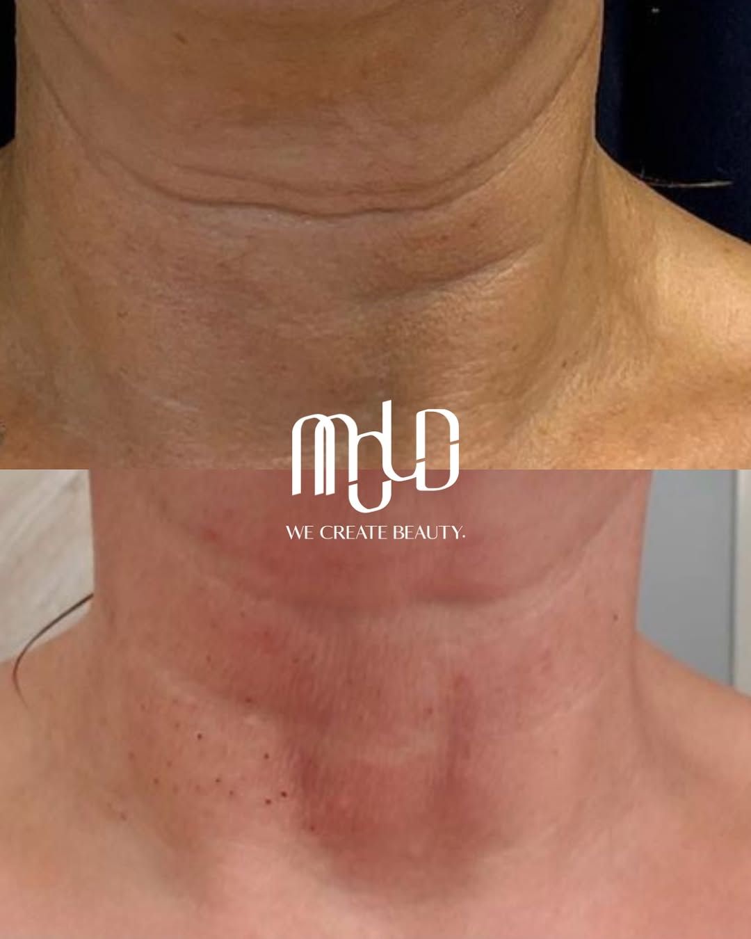 Visible improvement in neck laxity and skin quality following treatment. Visible improvement in neck laxity and skin quality following treatment.