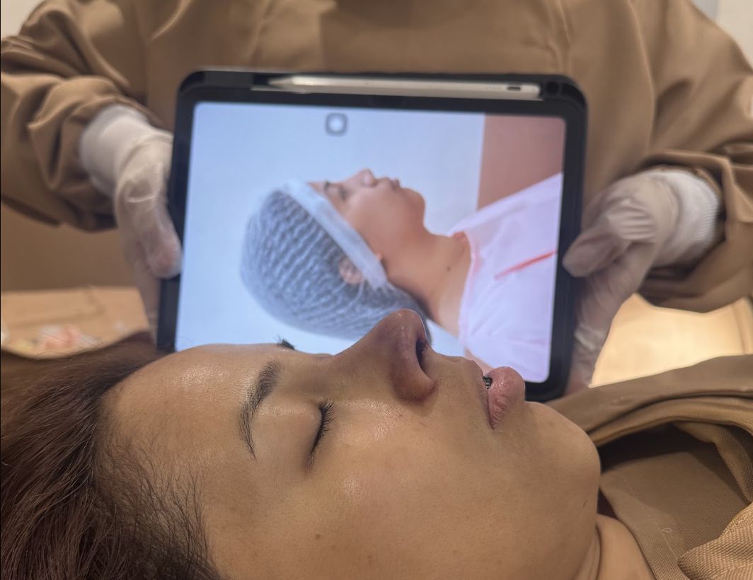 Patient recovery following open structural rhinoplasty.
