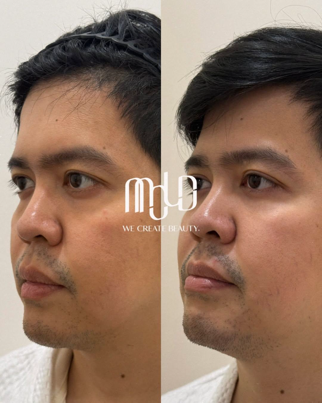 Side-by-side facial comparison showing changes after XERF treatment. Side-by-side facial comparison showing changes after XERF treatment.