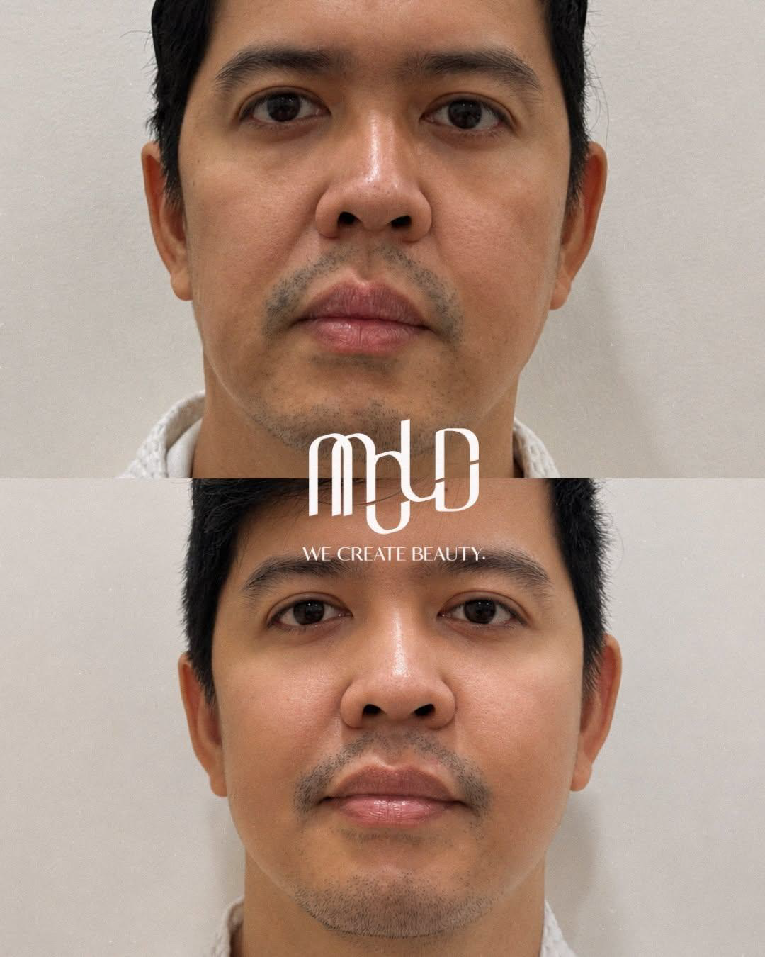 Facial comparison highlighting natural-looking changes following XERF treatment. Facial comparison highlighting natural-looking changes following XERF treatment.