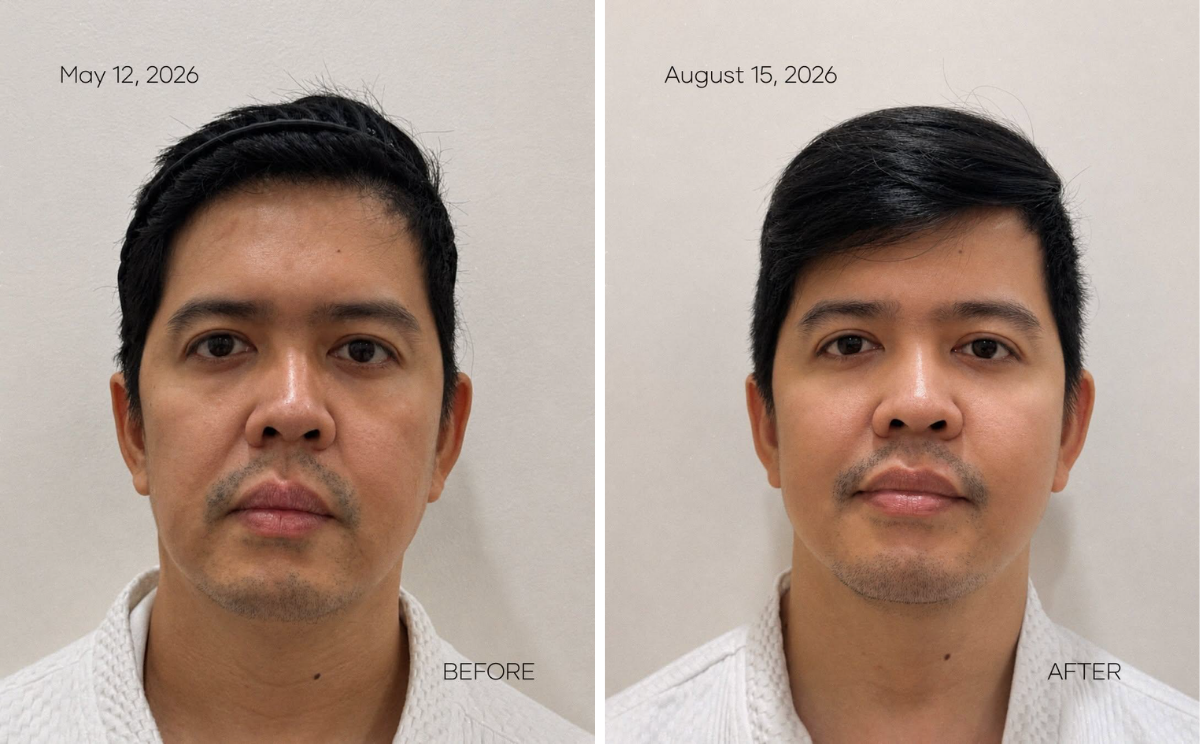 Three-month before-and-after comparison following XERF treatment. Three-month before-and-after comparison following XERF treatment.