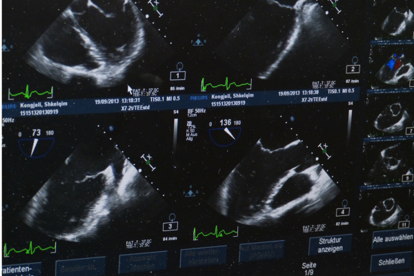 Doctor explaining lung cancer screening with CT scan to a former smoker aged 50–80 for early detection and prevention