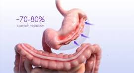 Manga Gástrica Endoscópica (ESG)